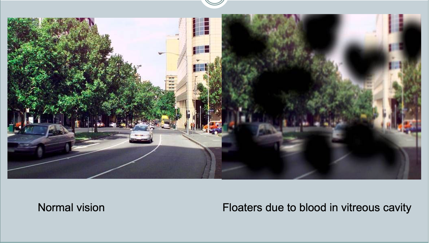 Diabetic Retinopathy | Sunway Eye Centre