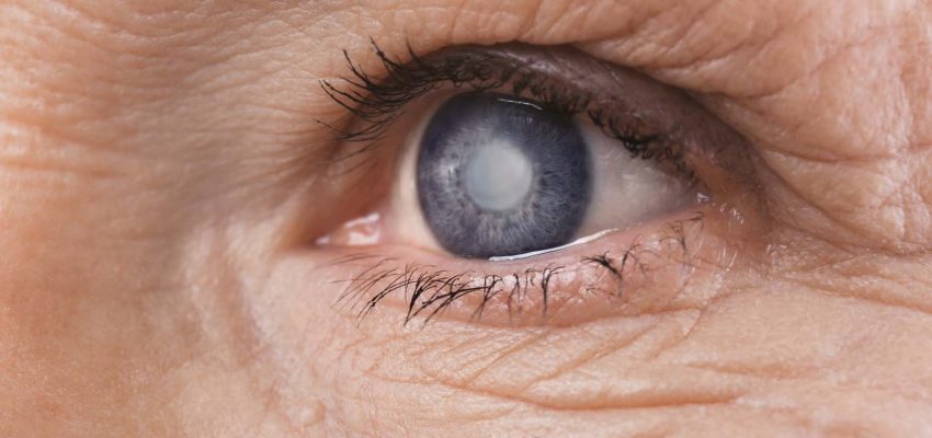 adult-cataract
