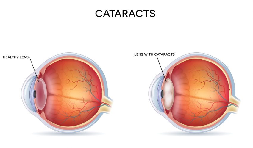 vision-cataract