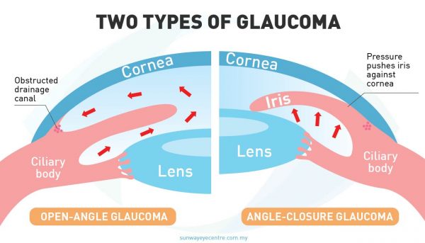 The Two Types Of Glaucoma: Primary Open Angle Glaucoma & Primary Angle ...