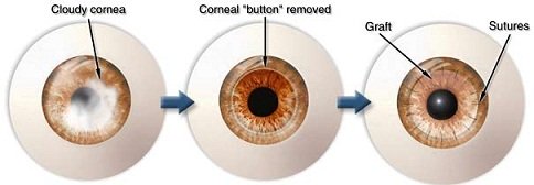 corneal transplant